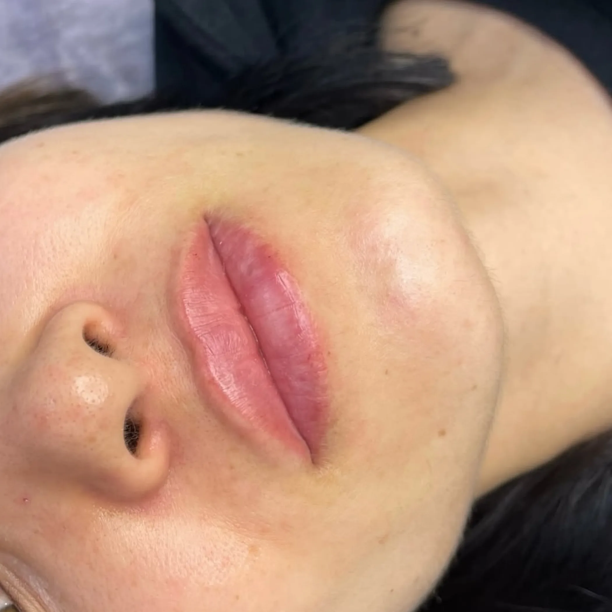 lip contour aesthetic treatment