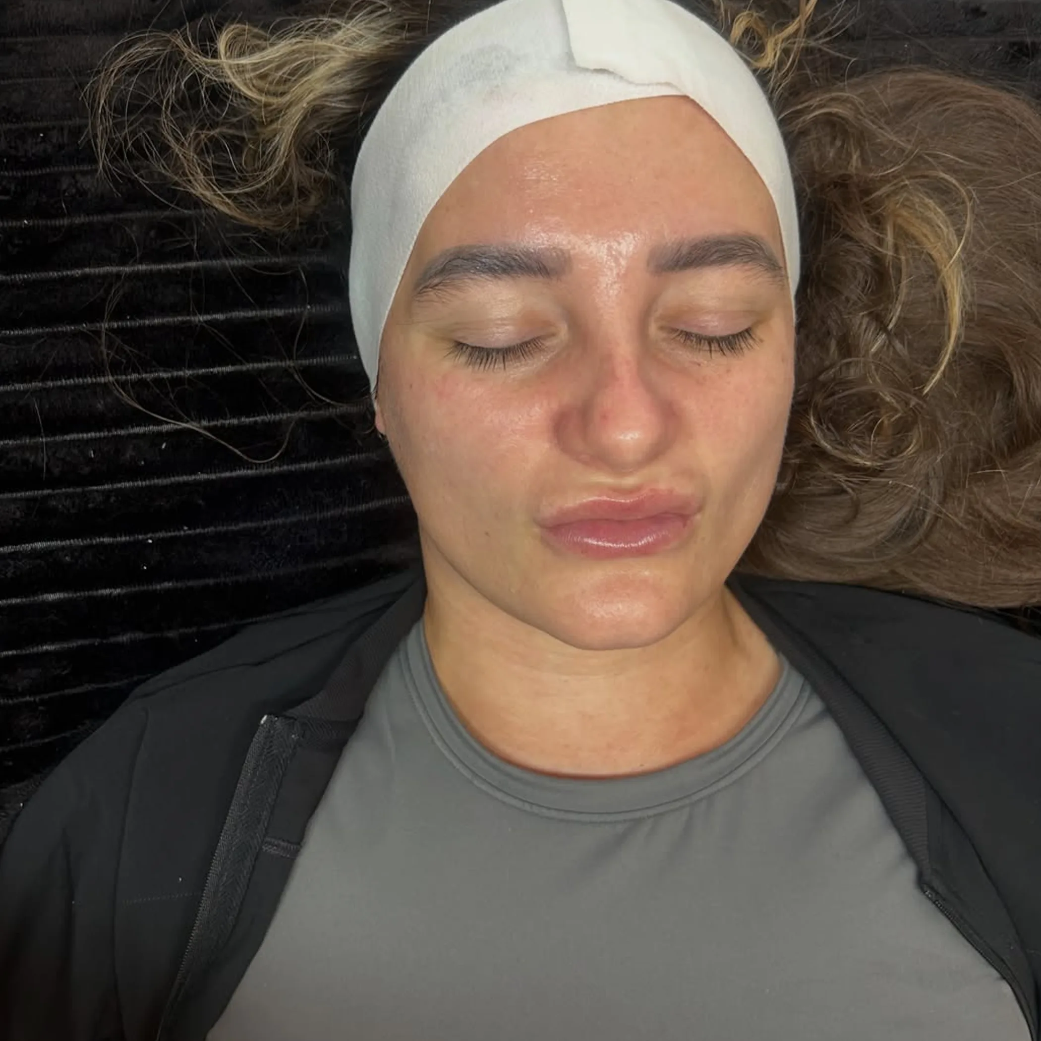 professional facial peel result